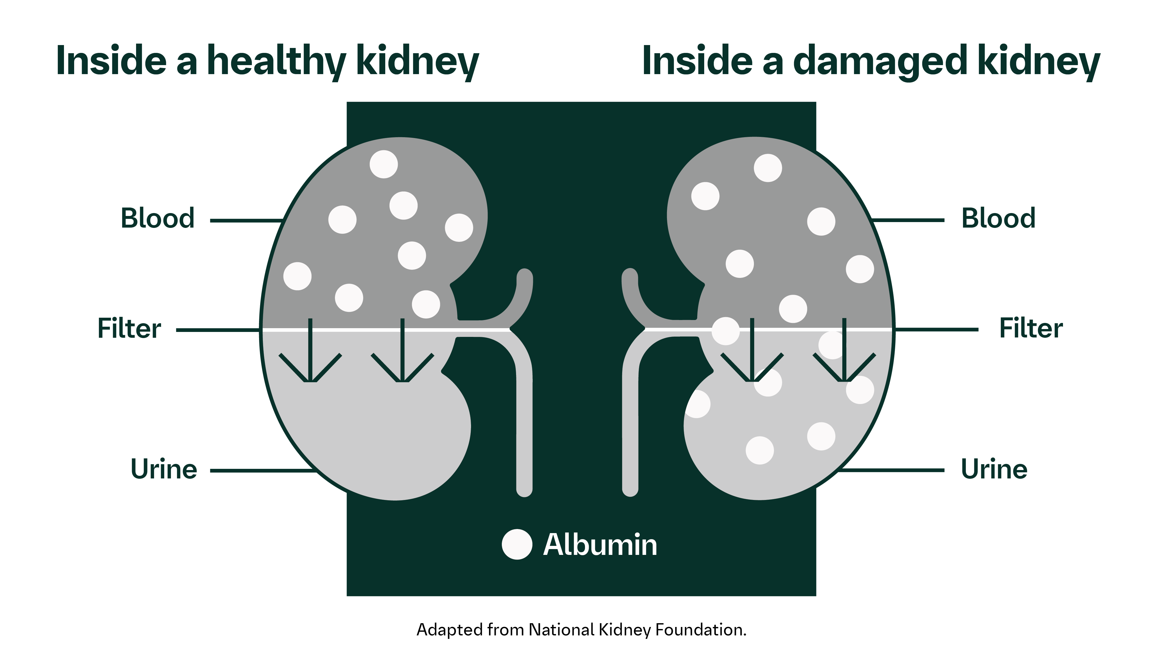 Comparison of a healthy kidney and a damaged kidney. Albumin is retained in the blood in the healthy kidney. The damaged kidney shows albumin leaking into the urine.
